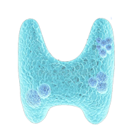 Nasopharyngeal carcinoma